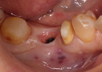 抜歯即時インプラント　抜歯と同時にインプラントを埋める方法